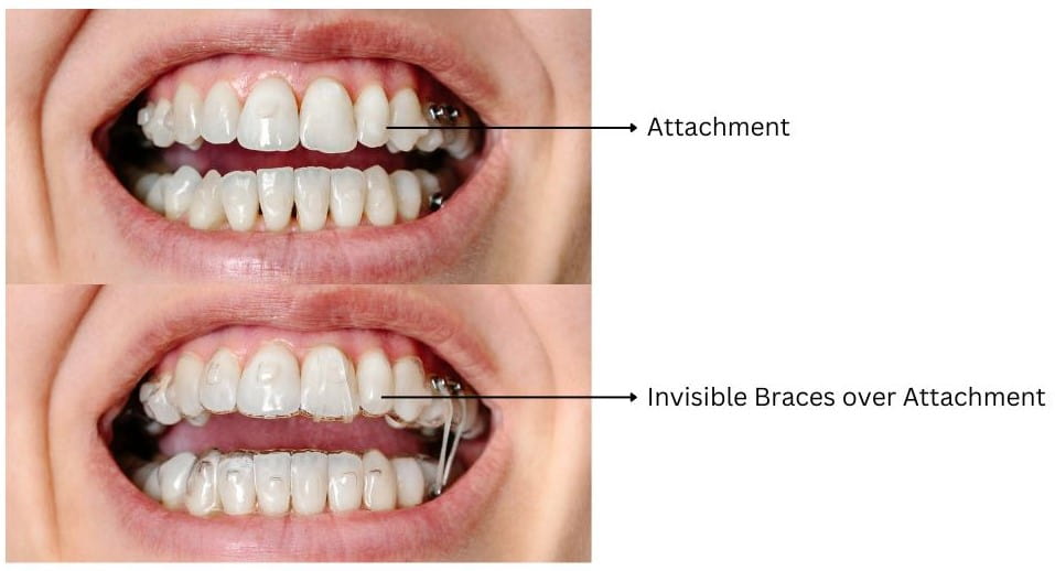 Clear aligner attachment