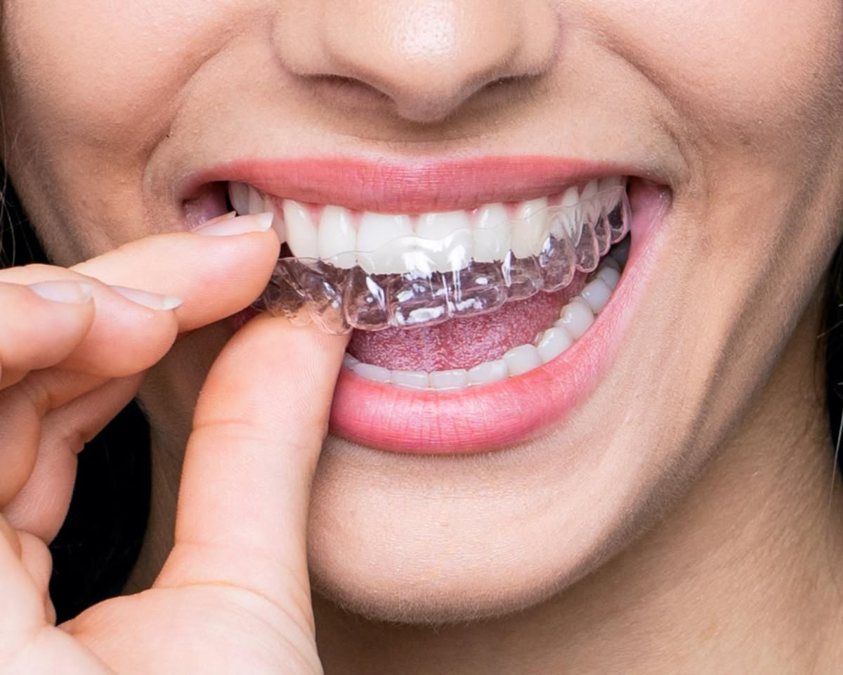 Clear aligners comparison