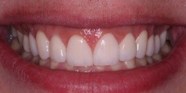 After treatment 3
