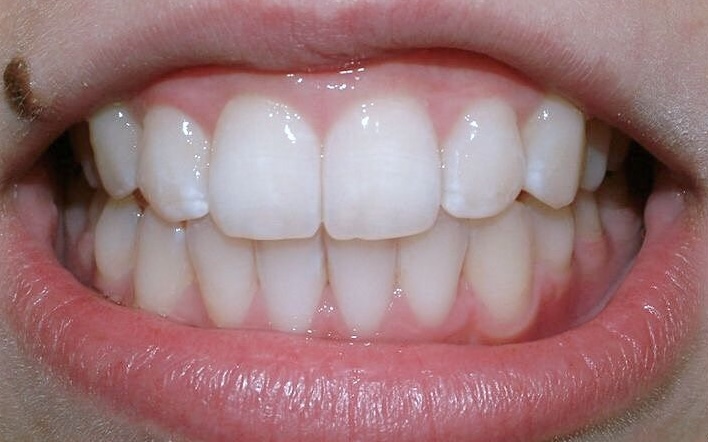After treatment 4
