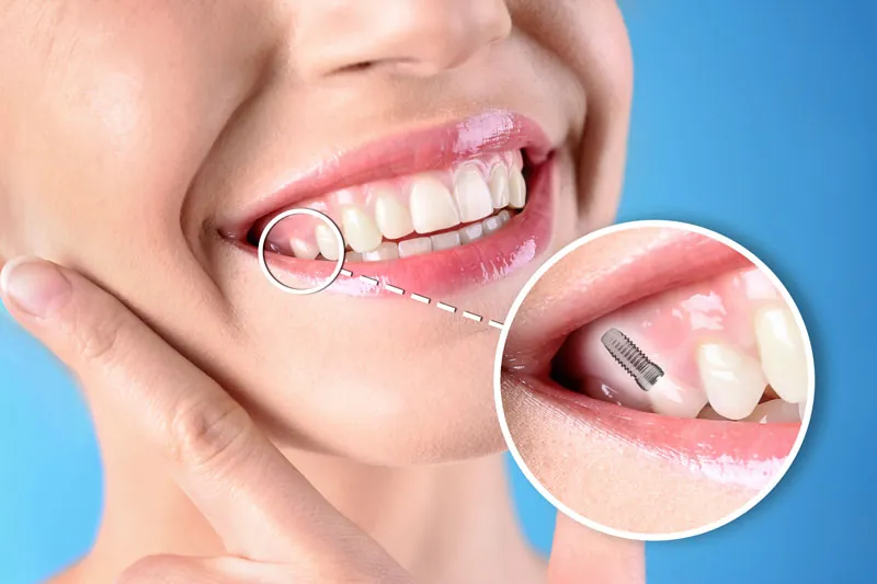 Dental implant placement