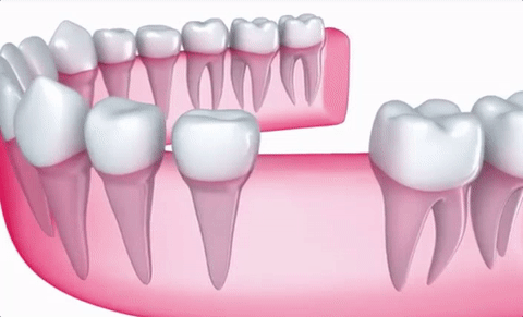 Dental implant illustration