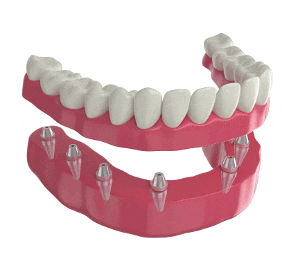 Implant supported dentures