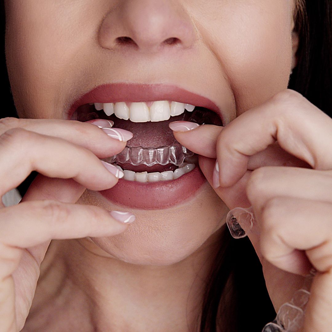 Clear dental aligners