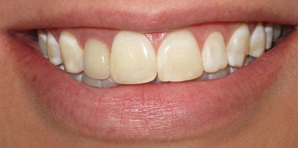 Pre-Treatment