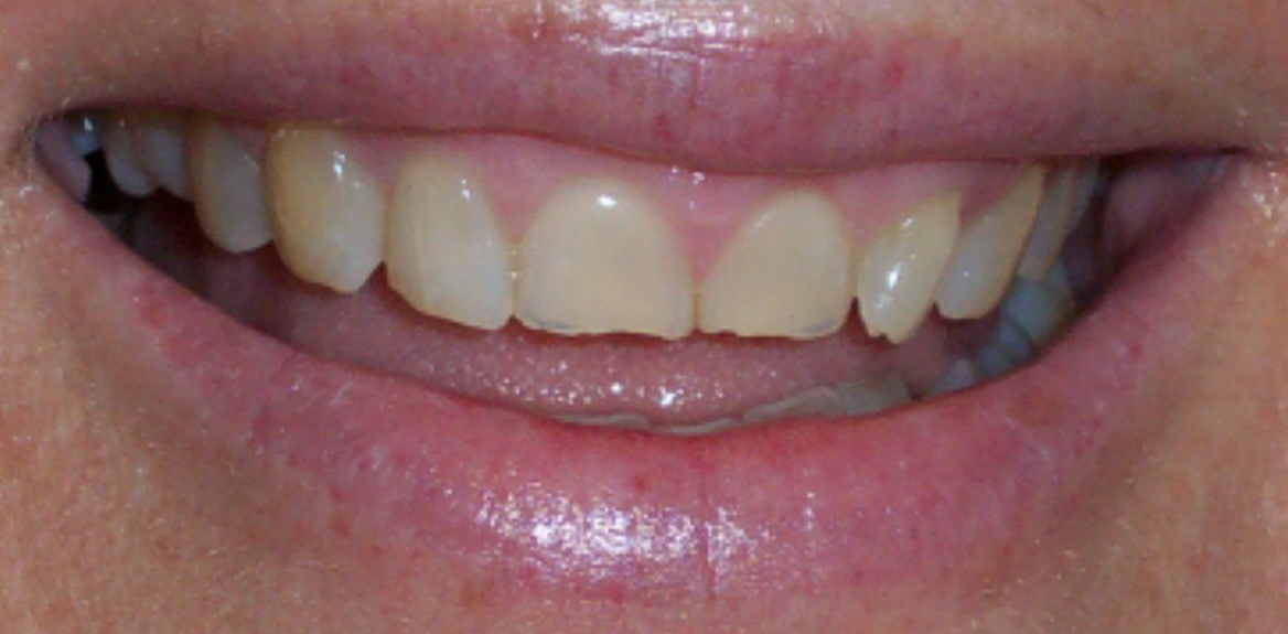 Pre-Treatment