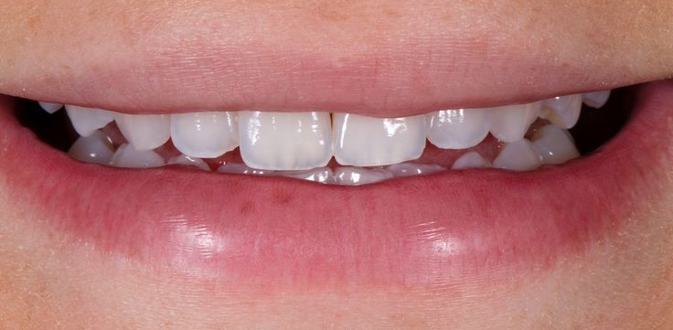 Pre-Treatment