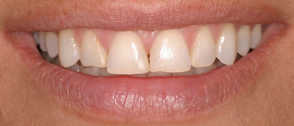 Pre-Treatment