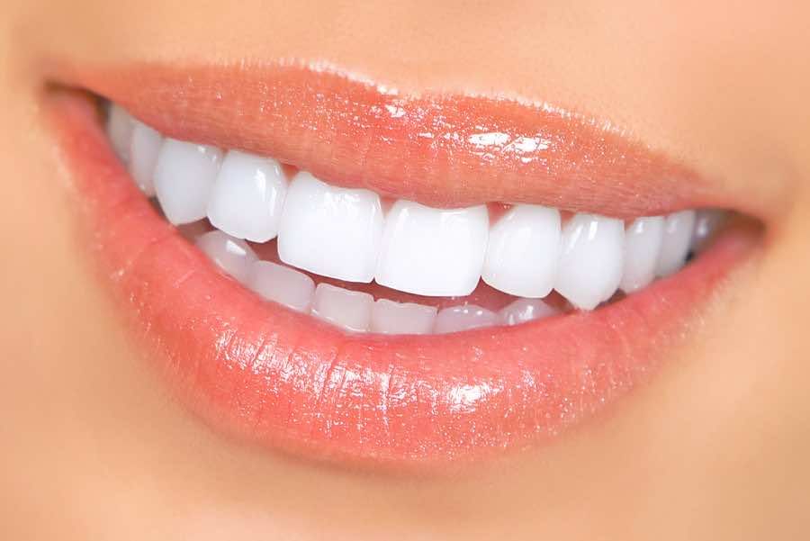 Whitening before veneers